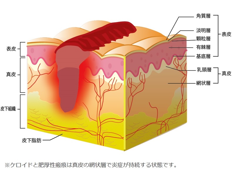 皮膚の真皮で炎症