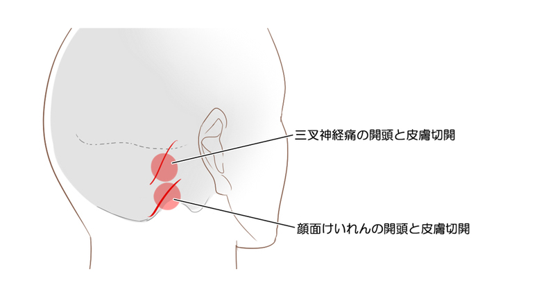 三叉神経痛も顔面けいれんの手術法 「微小血管神経減圧術」