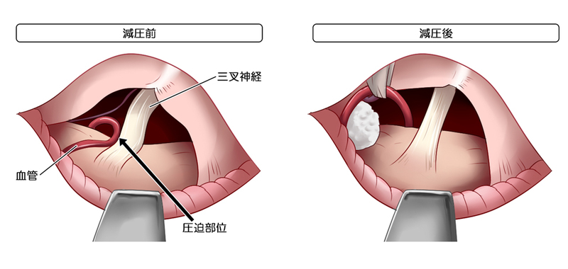三叉神経痛も顔面けいれんの手術法 「微小血管神経減圧術」