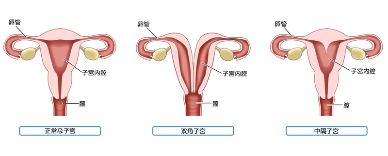 子宮形態異常