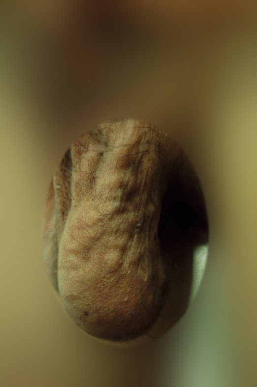 画像でみる精索静脈瘤（永尾光一先生より提供）