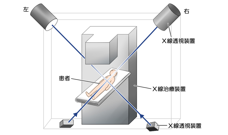 動体追跡放射線治療