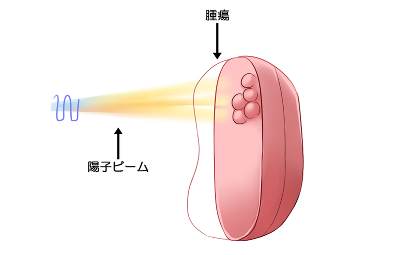 スポットキャニング法