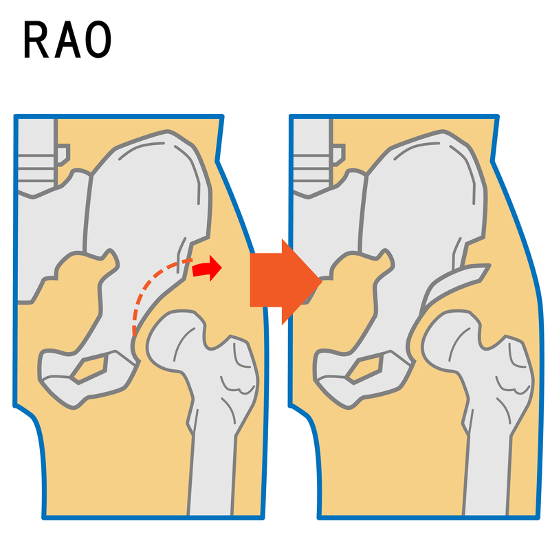 RAOー臼蓋を形成する手術