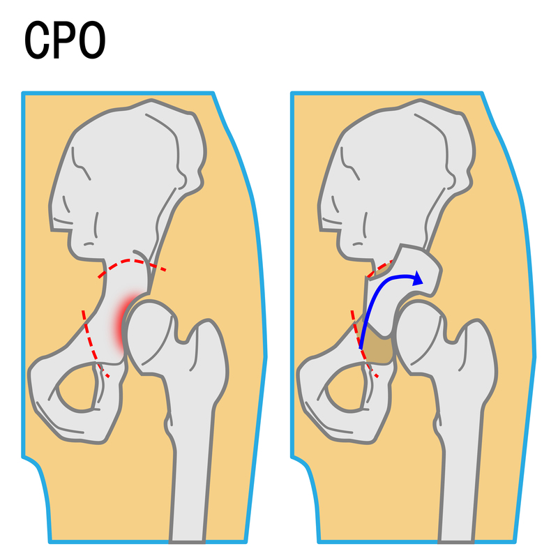 CPO-臼蓋を形成する手術