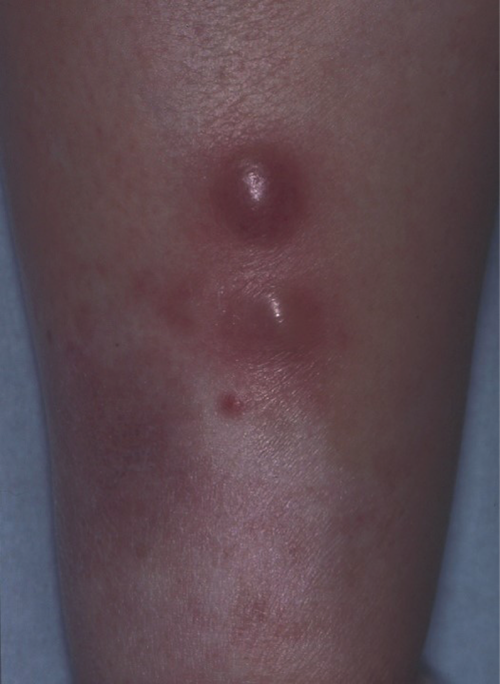 皮膚原発未分化大細胞型リンパ腫（ALCL）