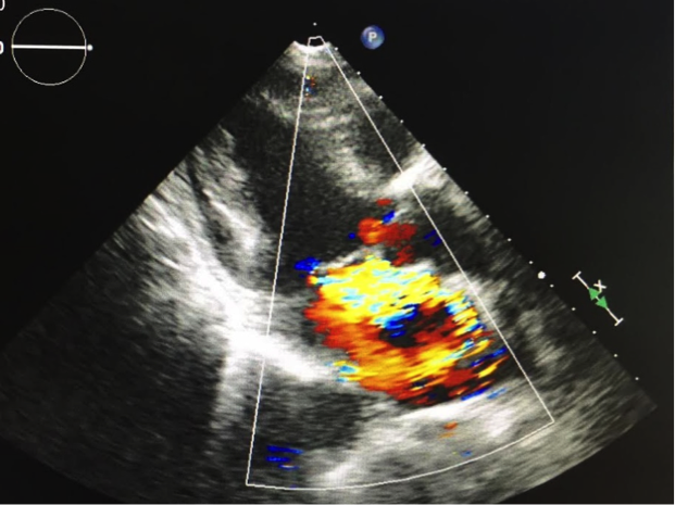 僧帽弁閉鎖不全症のエコー画像