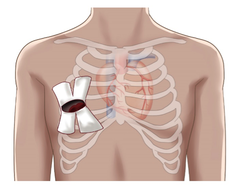 心臓弁膜症で小切開を加える部位と傷の大きさ