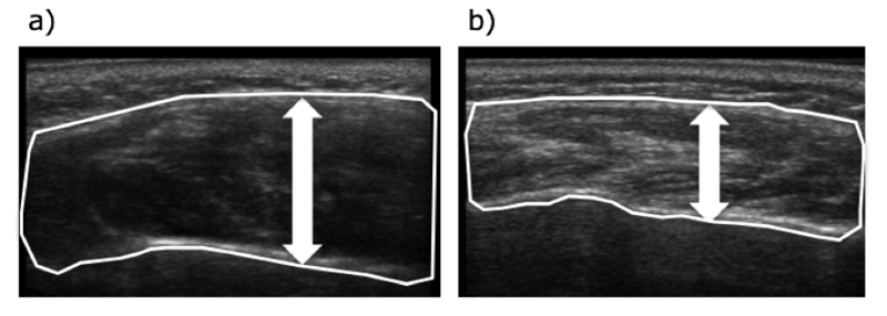 高齢者の咬筋エコー画像