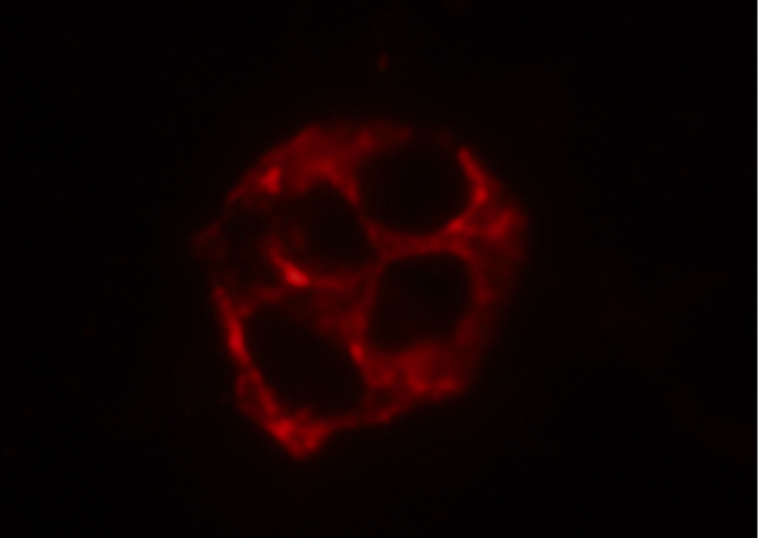 エプスタイン症候群の塗抹標本
