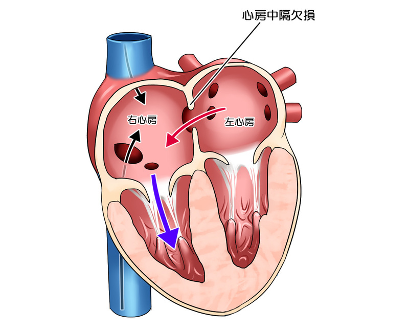 心房中隔欠損症の関連イラスト