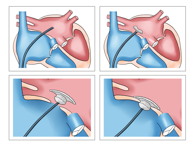心房中隔欠損症の治療方法