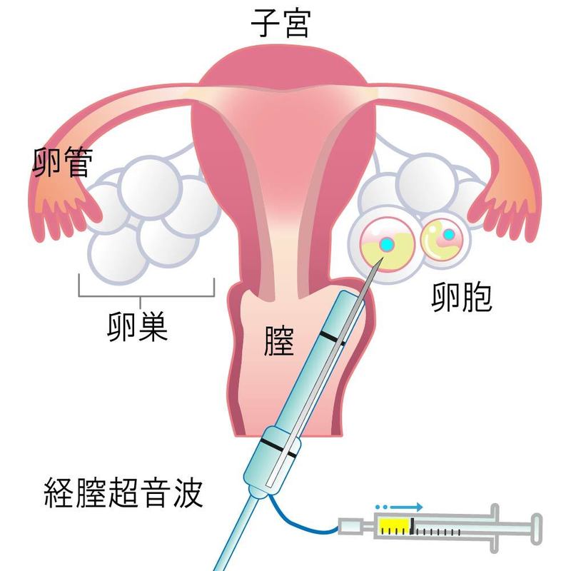 卵子凍結における採卵の方法