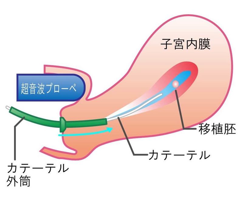 人工授精の手順