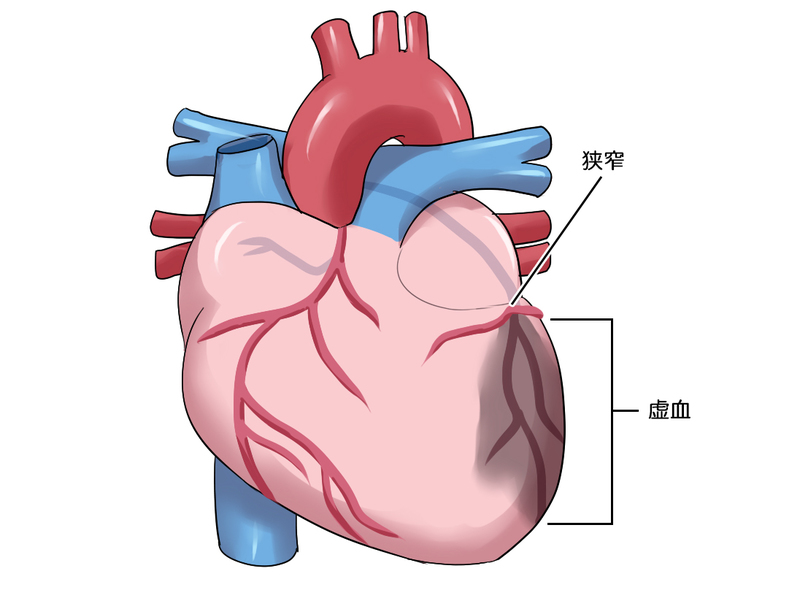 心臓の虚血