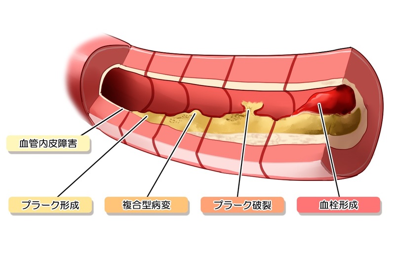 プラークの形成と破綻