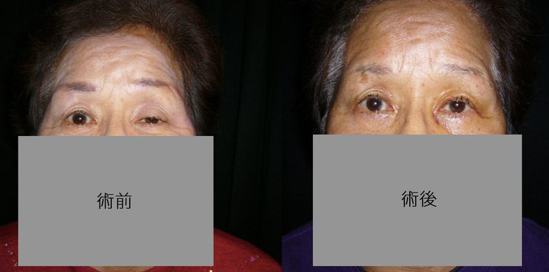 眼瞼下垂　術前・術後