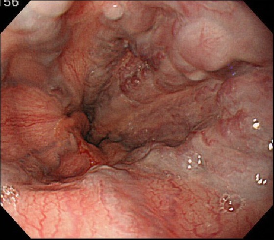 食道静脈瘤　写真