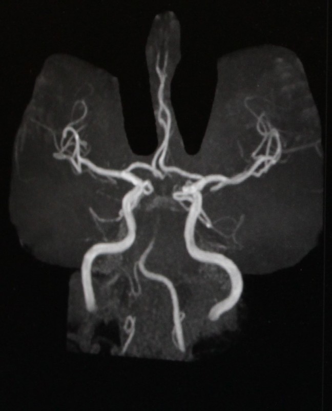 カテーテル治療前の画像