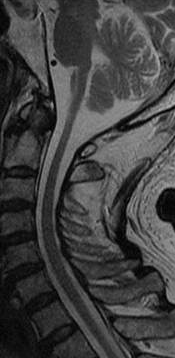 延髄・脊髄　MRI