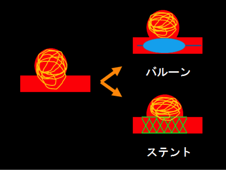 バルーンとステントの違い