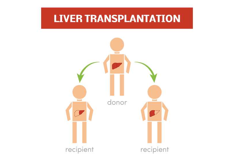 肝臓の生体移植