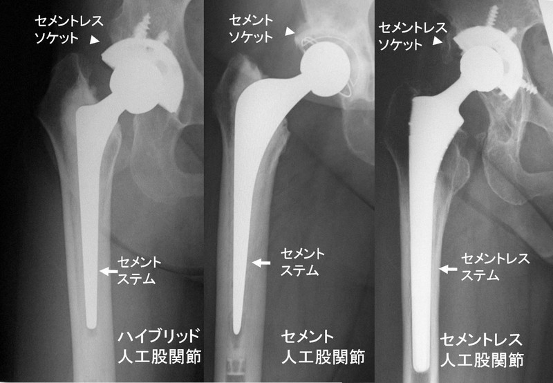 人工関節装着写真