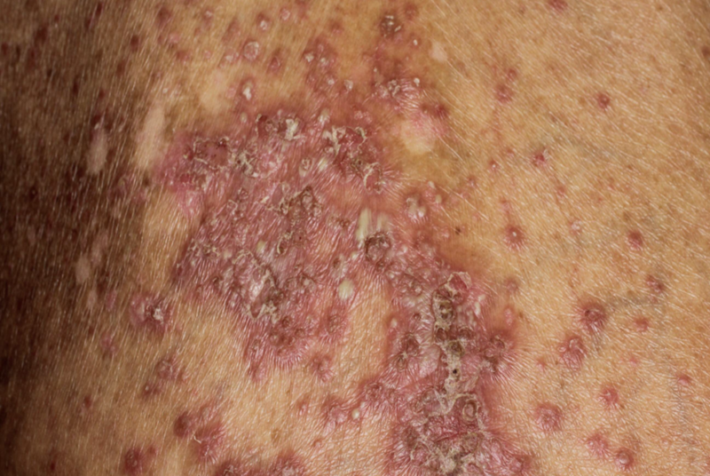 膿疱性乾癬　症状　写真