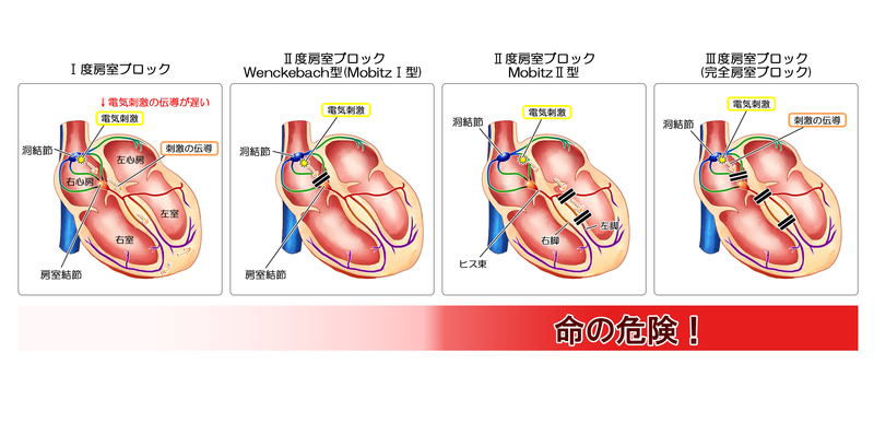 房室ブロックの危険性