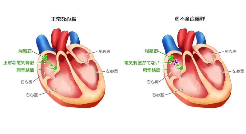 洞不全症候群の原因