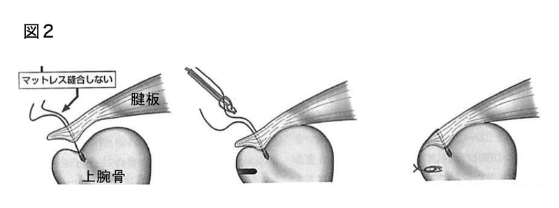 腱板断裂 麻生総合病院