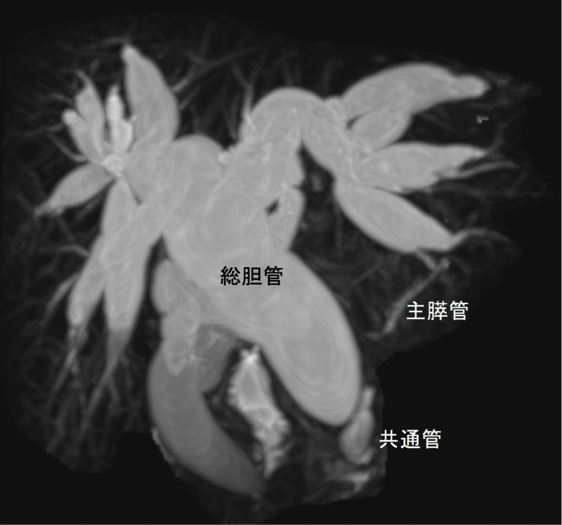 図：先天性胆道拡張症のMRCP像