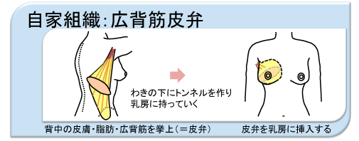 自家組織による乳房の再建