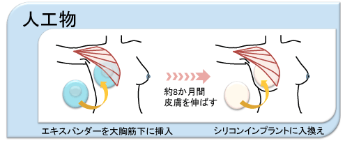 人工物による乳房再建