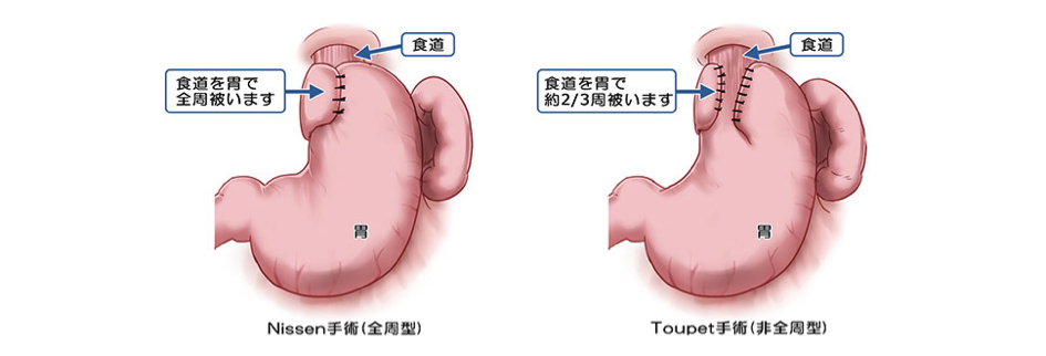 Nissen手術とToupet手術のイラスト説明