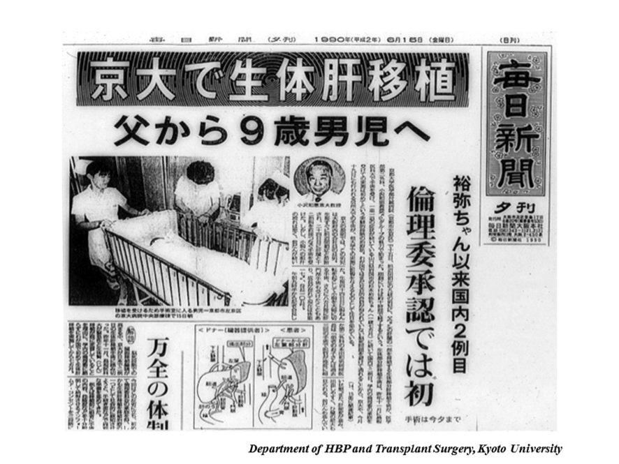 京都大学で国内2例目の生体肝移植が行われた1990年の報道