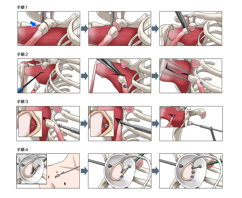 関節鏡視下バンカート＆ブリストウ法の手術方法