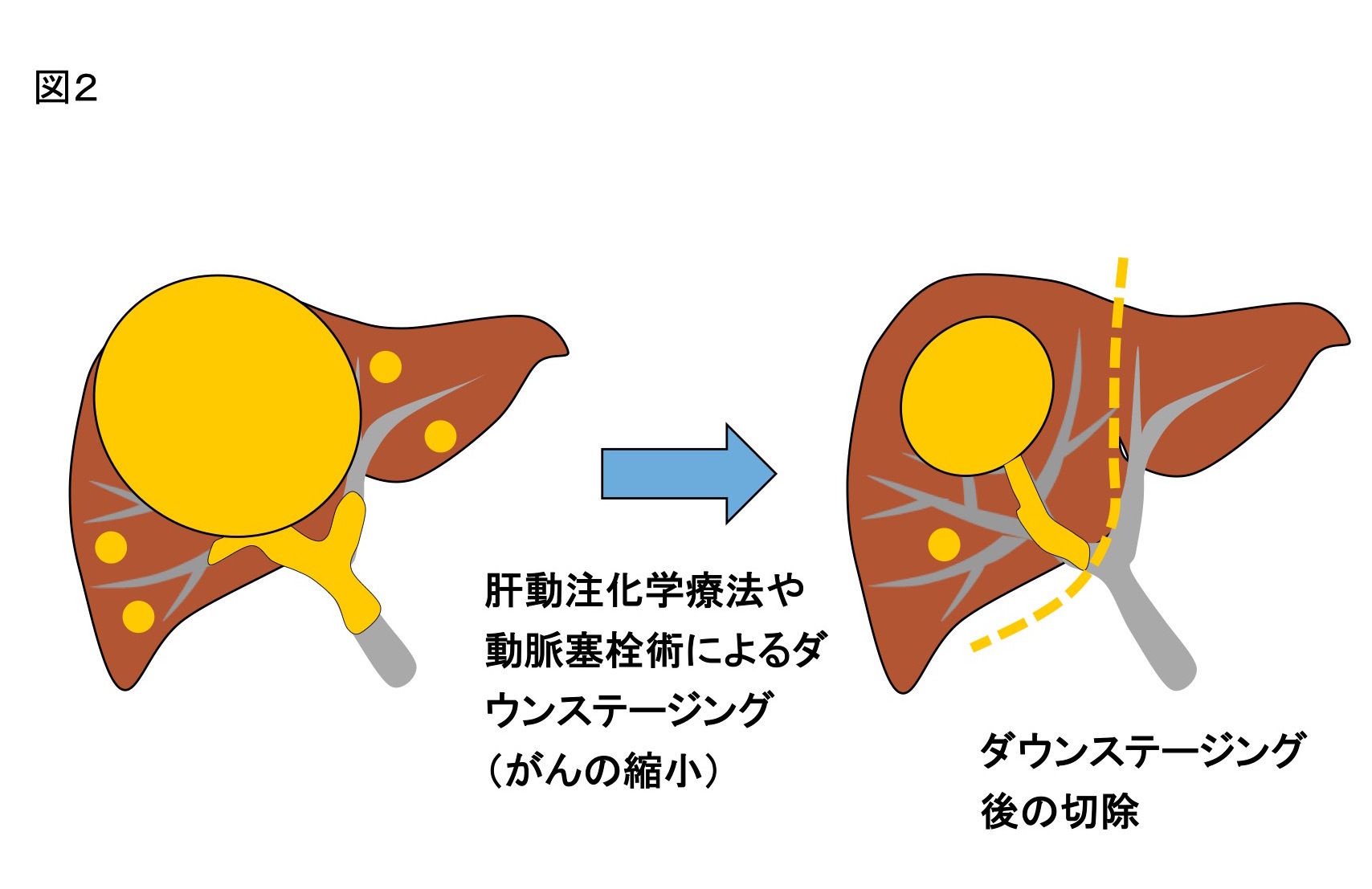 肝臓ガンのダウンステージングについて