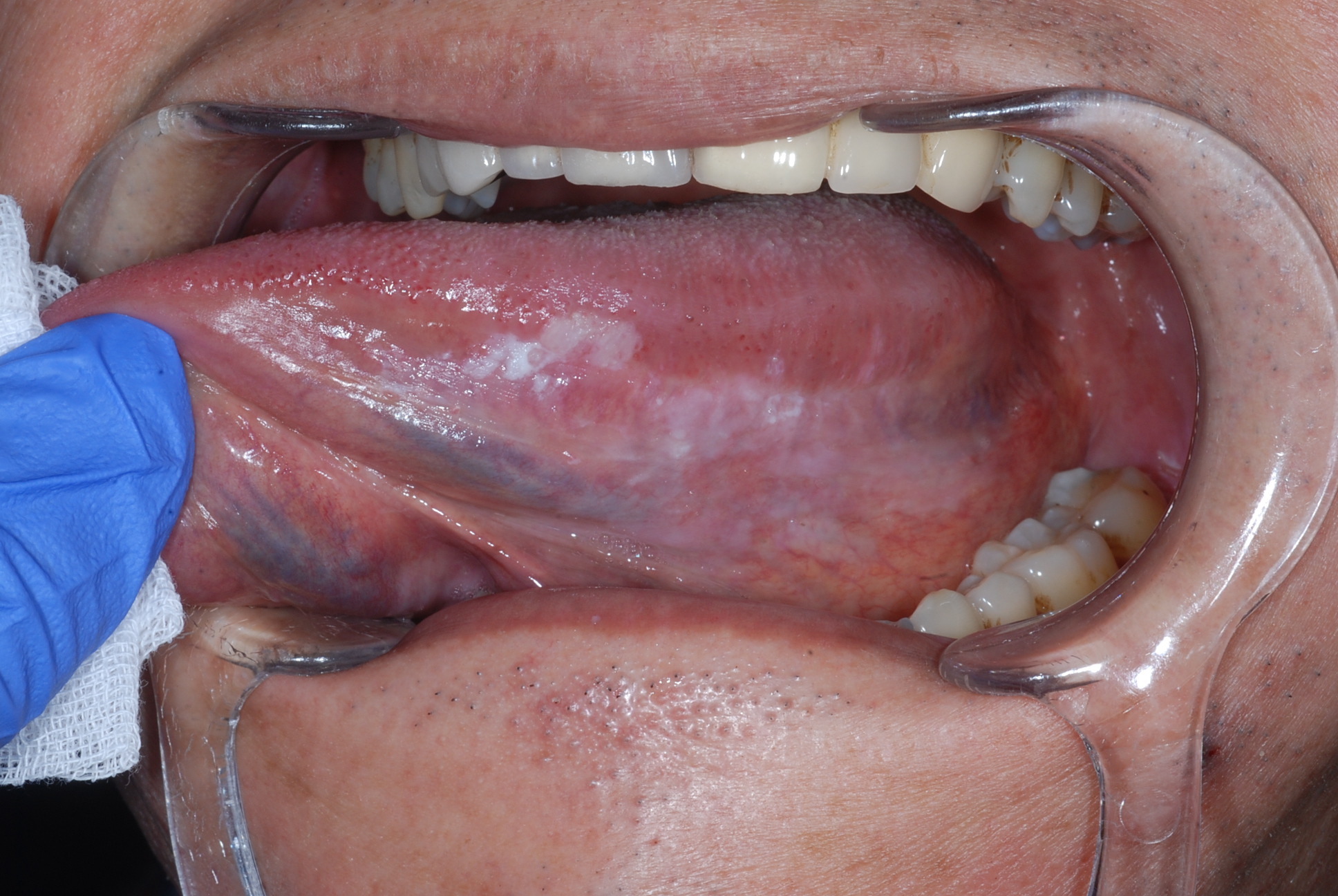 口腔白板症（こうくうはくばんしょう）とは－癌化の可能性もあり注意が必要 メディカルノート
