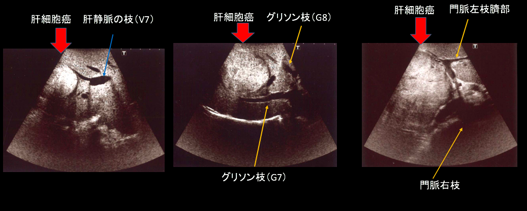 肝臓ガンの術中の超音波画像