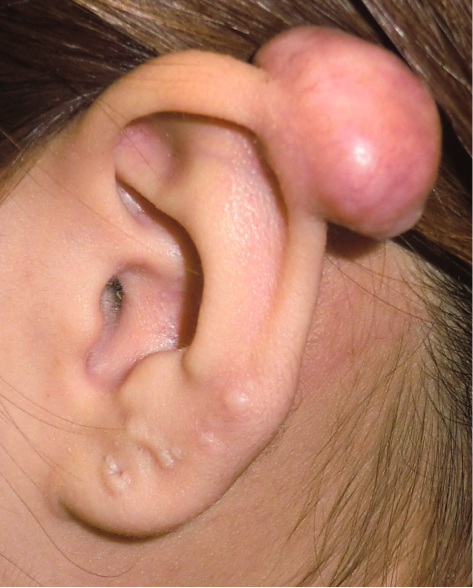 ニキビが原因で発症したケロイド