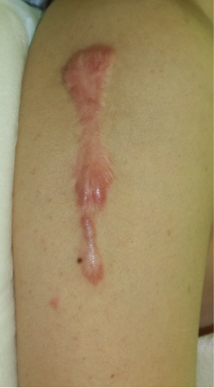 BCG注射によってできたケロイド