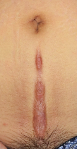 仁王切開によってできたケロイド