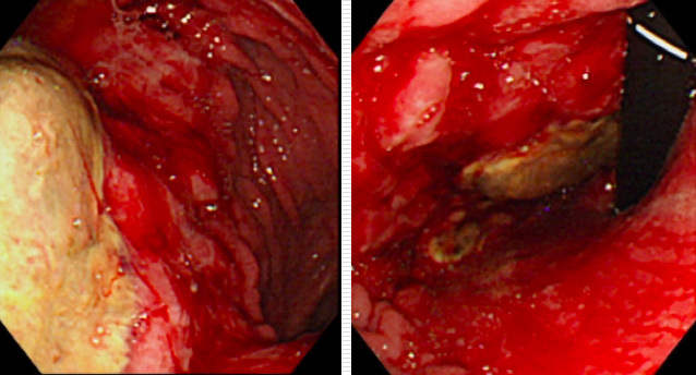 虚血性胃症の粘膜壊死