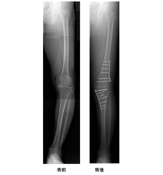 Double Level Osteotomyによる施術後のレントゲン画像