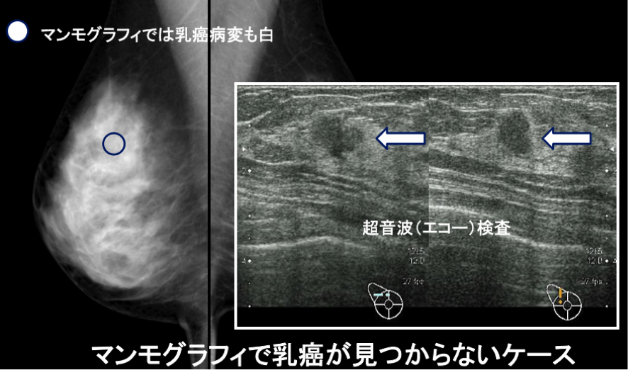 マンモグラフィで乳がんが見つからないケース