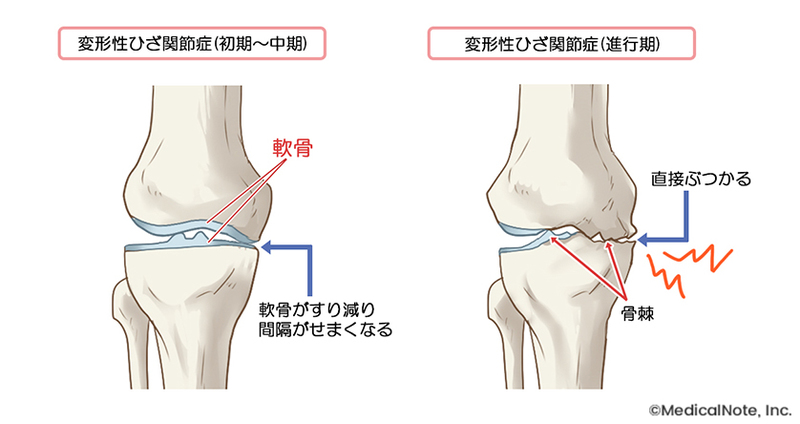 ＊変形性膝関節症の病態