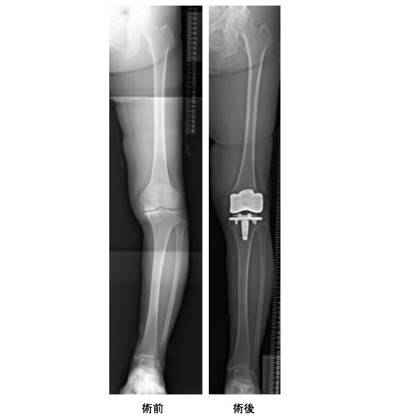 変形性膝関節症の手術療法――関節鏡から人工関節まで