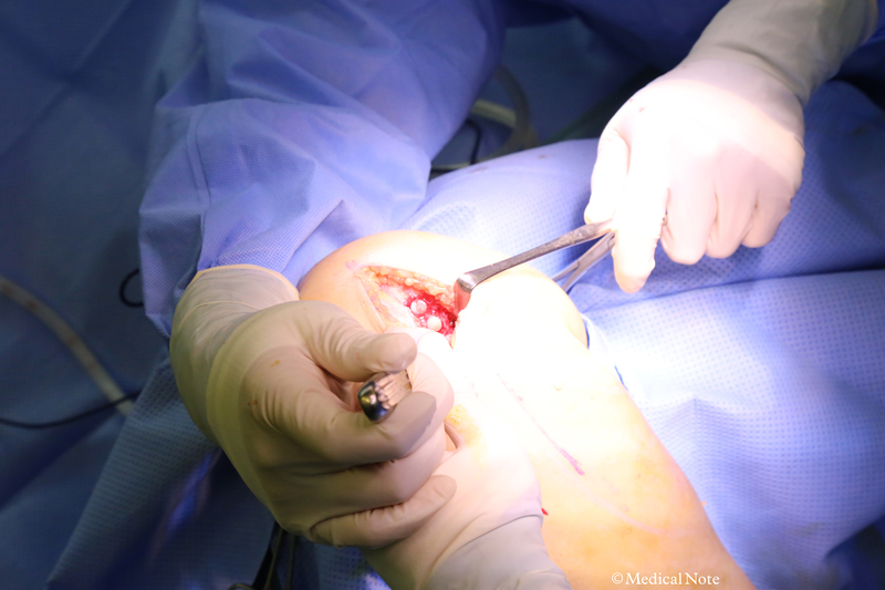 骨軟骨柱移植術（モザイクプラスティー）の追加