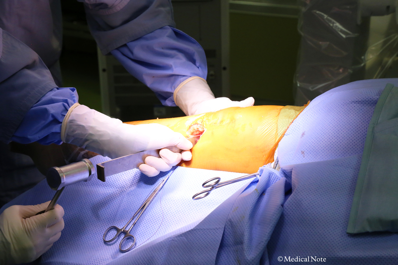 骨軟骨柱移植術（モザイクプラスティー）の追加